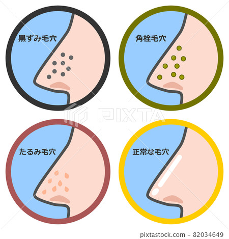 Illustration of a pattern showing the condition of the pores in the nose 82034649