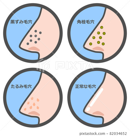 Illustration of a pattern showing the condition of the pores in the nose Illustration of a pattern showing the condition of the pores in the nose 82034652