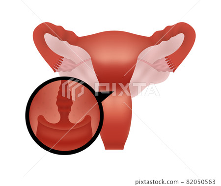 Realistic illustration of female human reproductive system on white background focus on cervix 82050563