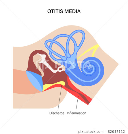 otitis media disease 82057112