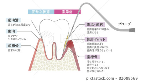 用探針檢查牙周病的插圖 82089569
