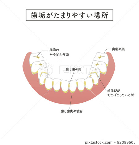 Illustration of a place where plaque tends to accumulate 82089603