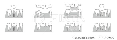 種植牙橋可摘局部義齒對比圖 82089609