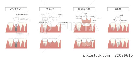 Implant bridge removable partial denture comparison illustration Implant bridge removable partial denture comparison illustration 82089610