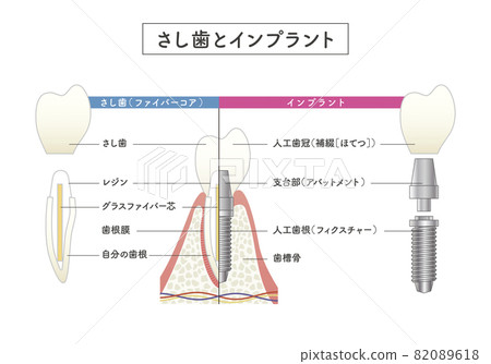 切牙與種植體對比圖 82089618