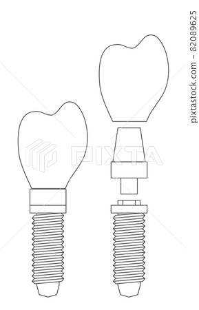 植入物的結構示意圖 植入物的結構示意圖 82089625