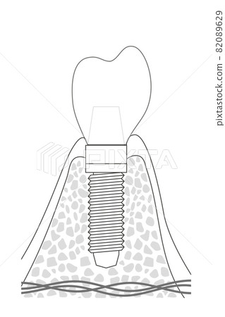 Structural illustration of implant Structural illustration of implant 82089629