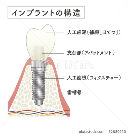 植入物的結構示意圖 82089630