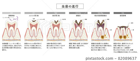 蛀牙進展的插圖 蛀牙進展的插圖 82089637