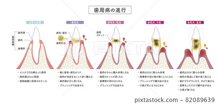 Progression of periodontal disease 82089639