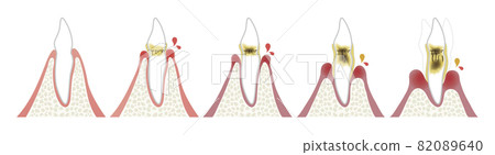 Progression of periodontal disease 82089640