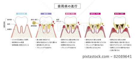 Progression of periodontal disease 82089641