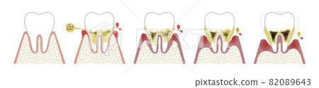 Progression of periodontal disease 82089643