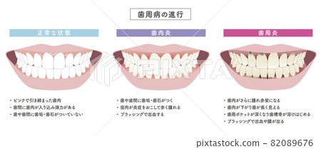 牙周病進展圖集 牙周病進展圖集 82089676