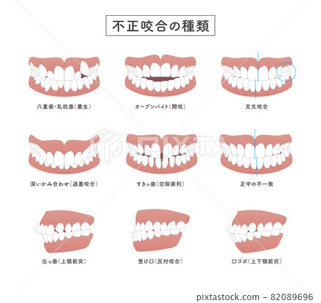 咬合不正類型集圖 咬合不正類型集圖 82089696