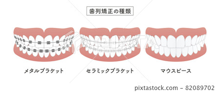 正畸類型設置圖 82089702