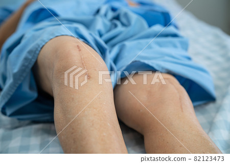 Asian senior or elderly old lady woman patient show her scars surgical total knee joint replacement Suture wound surgery arthroplasty on bed in nursing hospital ward, healthy strong medical concept. Asian senior or elderly old lady woman patient show her scars surgical total knee joint replacement Suture wound surgery arthroplasty on bed in nursing hospital ward, healthy strong medical concept. 82123473