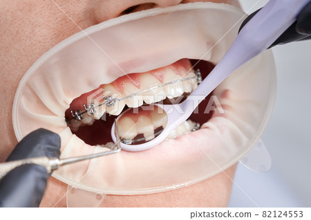 Close up of orthodontist placing orthodontic brackets on patient teeth. Person with cheek retractor and metal braces on teeth having dental procedure in clinic. Concept of orthodontic treatment. Close up of orthodontist placing orthodontic brackets on patient teeth. Person with cheek retractor and metal braces on teeth having dental procedure in clinic. Concept of orthodontic treatment. 82124553