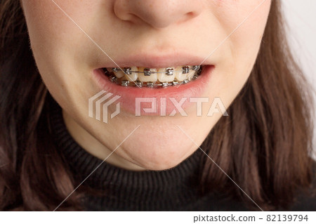 Orthodontic treatment. Dental care concept. Smiling teenage girl with braces. Metal braces close-up on the teeth. Orthodontic treatment. Dental care concept. Smiling teenage girl with braces. Metal braces close-up on the teeth. 82139794