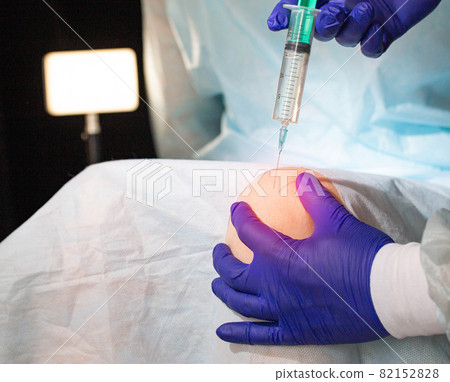 The doctor makes a therapeutic intra-articular injection into the knee joint to relieve inflammation and pain. Therapeutic injections of chondroitin and glucosamine, the introduction of hilauric acid The doctor makes a therapeutic intra-articular injection into the knee joint to relieve inflammation and pain. Therapeutic injections of chondroitin and glucosamine, the introduction of hilauric acid 82152828