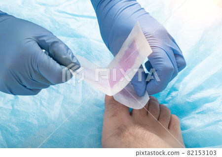 The doctor removes hair from toes with epilating wax strips. Hygiene and cosmetology concept, close-up The doctor removes hair from toes with epilating wax strips. Hygiene and cosmetology concept, close-up 82153103