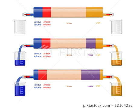intracranial pressure and cerebral haemodynamics, The Monro-Kellie Doctrine Regarding Intracranial Compensation for Expanding Mass 2d 82164252