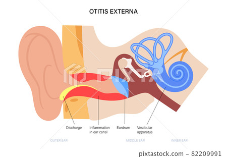 Swimmers ear otitis Swimmers ear otitis 82209991