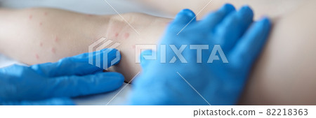 Doctor examining red rash on legs of child in clinic closeup Doctor examining red rash on legs of child in clinic closeup 82218363
