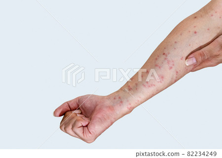 被毛毛蟲咬後漲紅的手臂 被毛毛蟲咬後漲紅的手臂 82234249