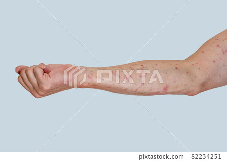 Arm up that swells red after being bitten by a caterpillar 82234251