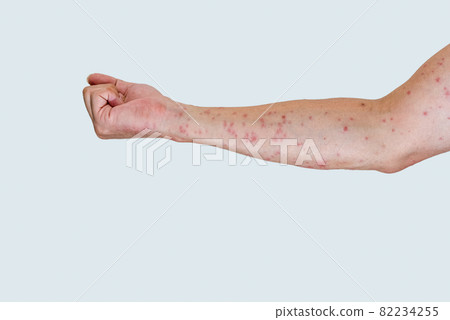 被毛毛蟲咬後漲紅的手臂 82234255