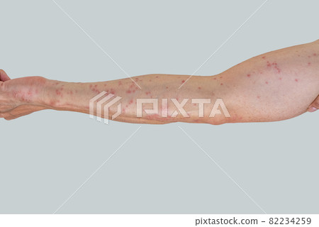 被毛毛蟲咬後漲紅的手臂 被毛毛蟲咬後漲紅的手臂 82234259