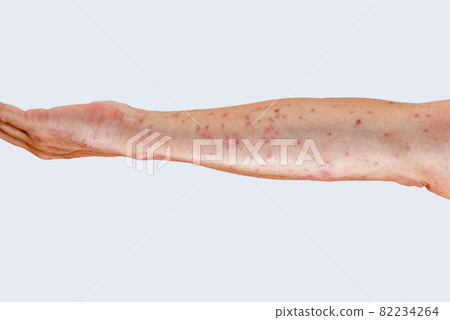 Arm up that swells red after being bitten by a caterpillar 82234264