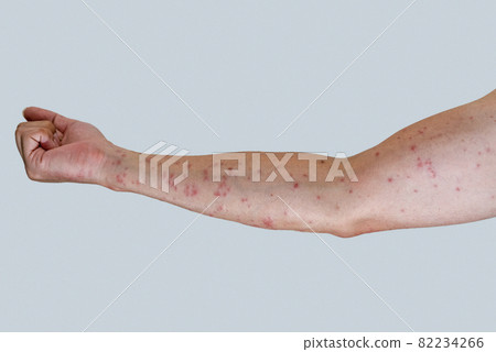 Arm up that swells red after being bitten by a caterpillar 82234266