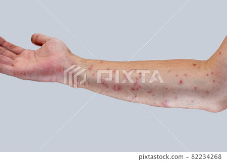 被毛毛蟲咬後漲紅的手臂 被毛毛蟲咬後漲紅的手臂 82234268