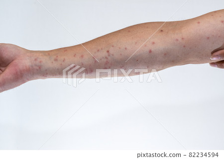 Arm up that swells red after being bitten by a caterpillar 82234594