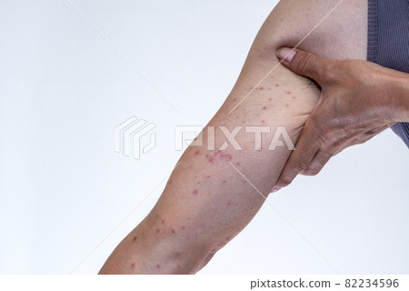 Arm up that swells red after being bitten by a caterpillar 82234596