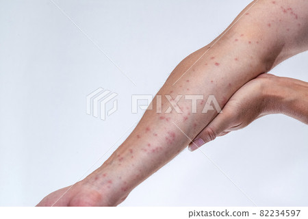 被毛毛蟲咬後漲紅的手臂 被毛毛蟲咬後漲紅的手臂 82234597