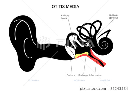 otitis media disease otitis media disease 82243384