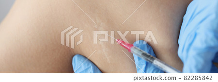 Doctor in gloves injecting medicine into scar on skin of patient leg closeup 82285842