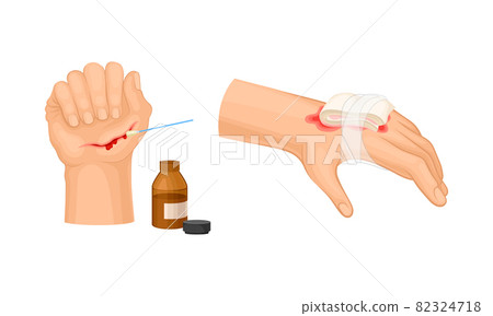 Skin burn injury treatment. Hurt human hand... - Stock Illustration ...