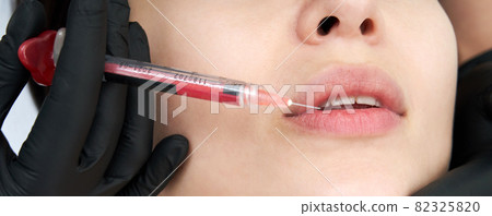 Beautiful woman gets an injection in her lips 82325820