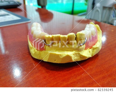 Mandibular partial denture Mandibular partial denture 82339245