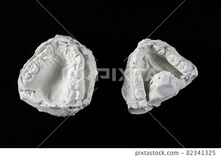 Teeth cast mold of the jaw made of plaster for orthodonist work Teeth cast mold of the jaw made of plaster for orthodonist work 82341325