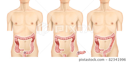 插圖素材：直腸/乙狀結腸癌004（真實） 82341996