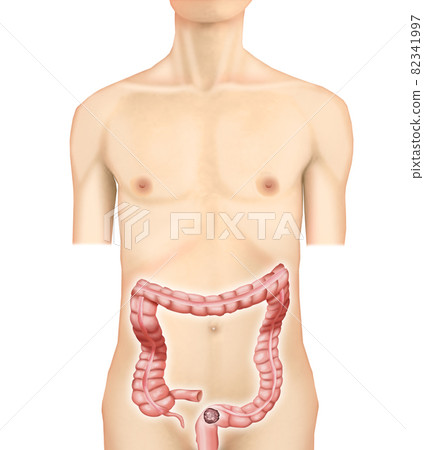 插圖素材：直腸/乙狀結腸癌001（真實） 82341997