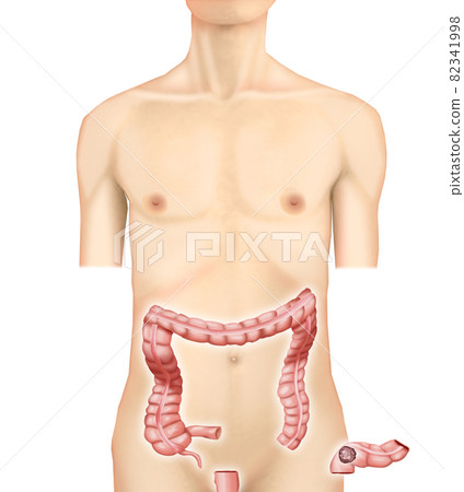 插圖素材：直腸/乙狀結腸癌002（真實） 82341998