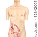 Illustration material: Descending colon cancer 003 (real) 82342006