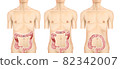 Illustration material: Transverse colon cancer 004 (real) 82342007