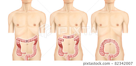 Illustration material: Transverse colon cancer 004 (real) 82342007